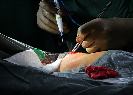 pacemaker implantation