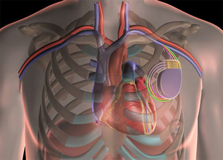 cardiac device implantation treatment