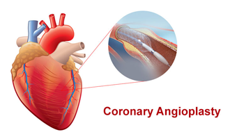 coronary angioplasty treatment in south delhi