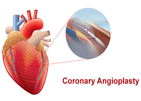 coronary angioplasty treatment